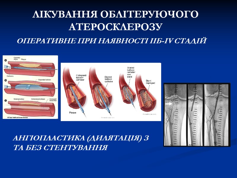 ЛІКУВАННЯ ОБЛІТЕРУЮЧОГО АТЕРОСКЛЕРОЗУ ОПЕРАТИВНЕ ПРИ НАЯВНОСТІ ІІБ-IV СТАДІЙ АНГІОПЛАСТИКА (ДИЛЯТАЦІЯ) З ТА ЛІКУВАННЯ ОБЛІТЕРУЮЧОГО АТЕРОСКЛЕРОЗУ ОПЕРАТИВНЕ ПРИ НАЯВНОСТІ ІІБ-IV СТАДІЙ АНГІОПЛАСТИКА (ДИЛЯТАЦІЯ) З ТА
